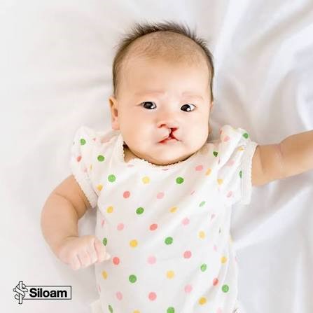 14)	Bayi dengan Sumbing 