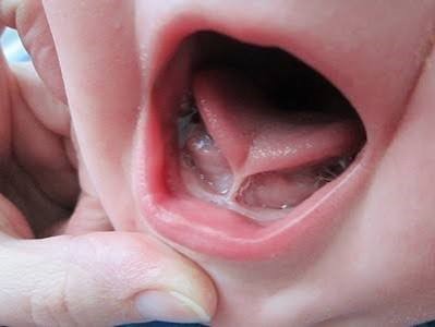 2)	Lidah Pendek/ Tongue Tie 
