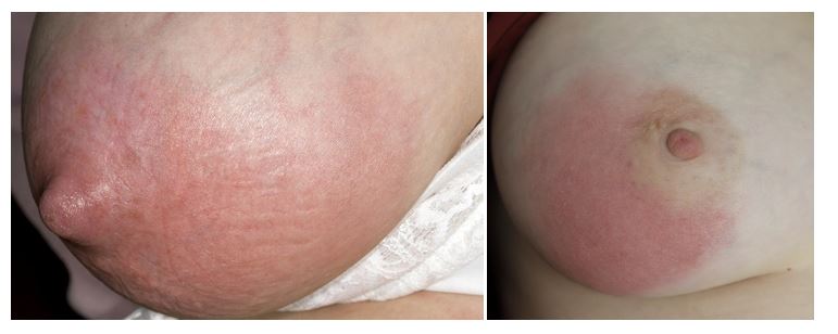 6)	Mastitis 