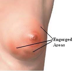 5)	Payudara Bengkak dan Sakit (Engorgement)